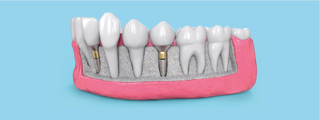 model of teeth with fillings
